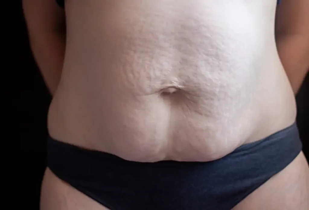 Foto Diastasi Addominale