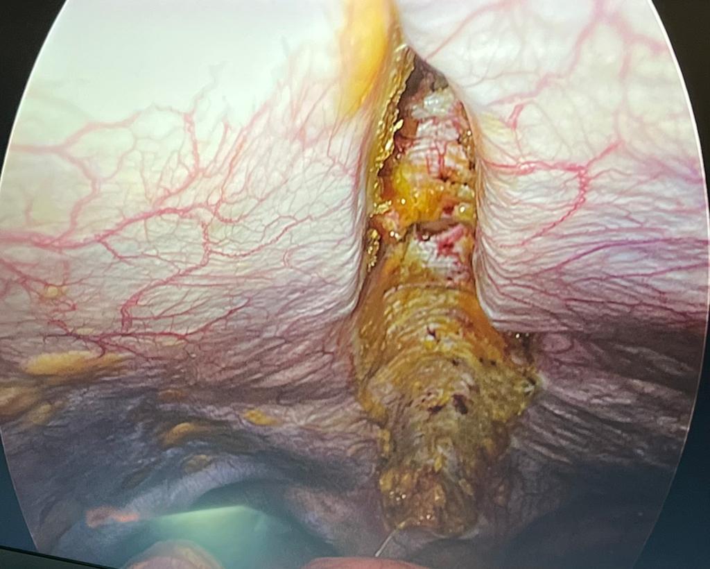 Tecnica chirurgica MISAR per Diastasi Addominale